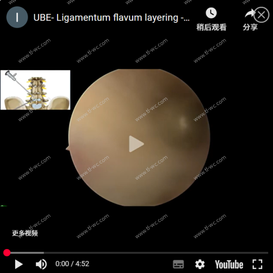 UBE-黄韧带分层-Corner 区进入椎管进行AYDEFY手术