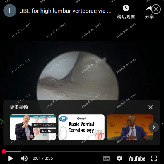 高位腰椎的UBE经椎弓根入路：一切为了彻底