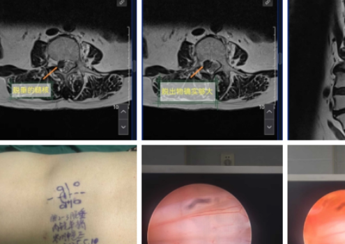 经皮内镜下腰椎间盘切除术